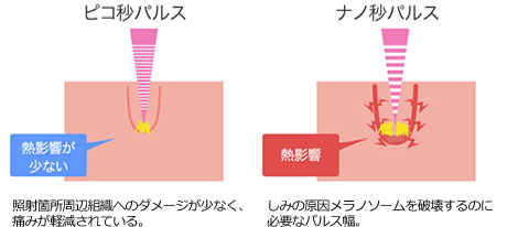 ピコレーザー治療